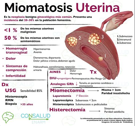 cid miomatose uterina